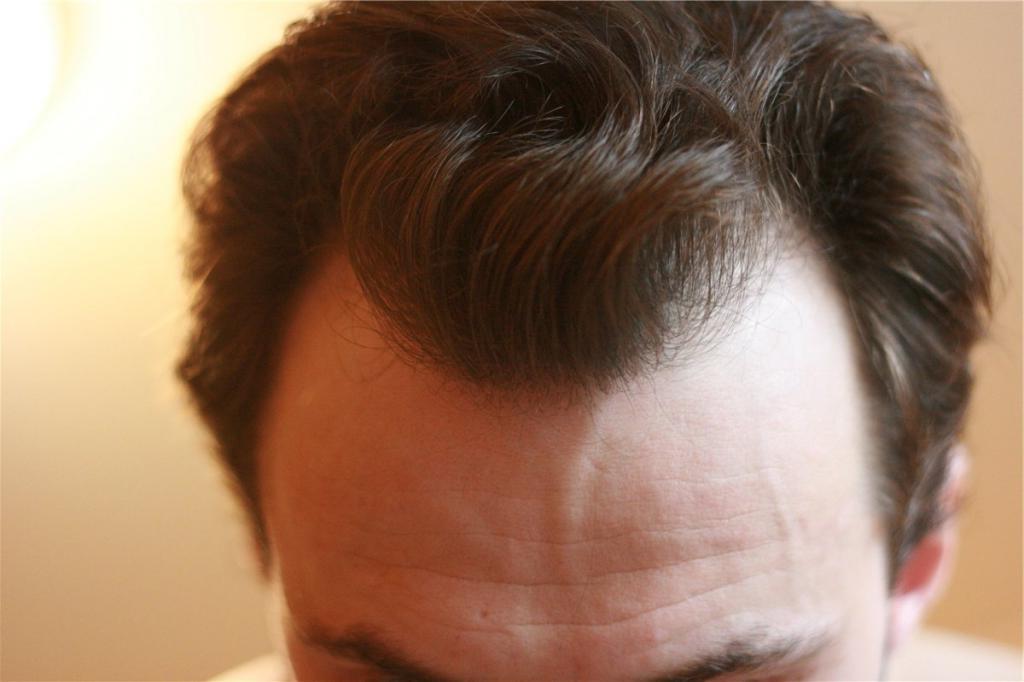 Лоб 5 см. Линия волос у мужчин. Мужская линия роста волос. Линия волос на лбу у мужчин. Линин роста волос мужчин.