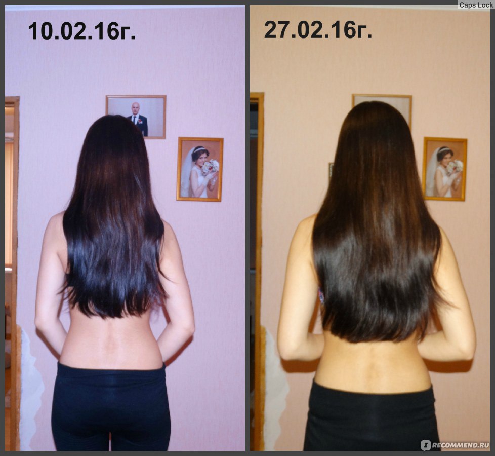 Волосы за 6 месяцев. Волосы до после. Волосы отрасли за два года. Никотиновая кислота для роста волос. Никотиновая кислота для волос до и после.